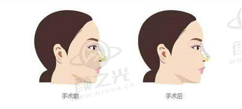 合肥艺星孙洋医生：BSK 半肋骨鼻综合 18000 元起！榫卯搭建法 + 双重缝合，美鼻自然挺翘