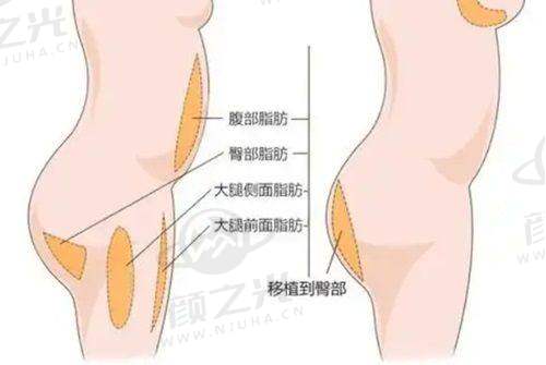 私密松弛怎样能变紧致？注射1 - 2支胶原蛋白或玻尿酸即可见效，真的无副作用吗？ 