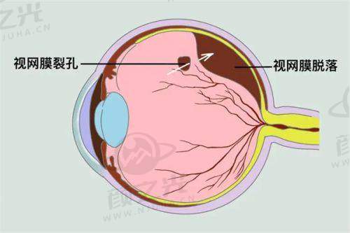 特色治疗费用：近视手术和眼部整形大比拼