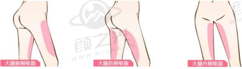 二、影响乔雅登玻尿酸丰脸价格的因素