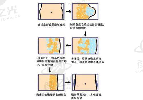 杭州维多利亚医疗美容医院胸部整形费用