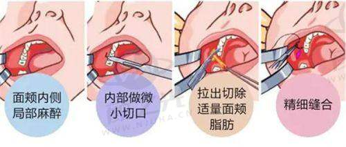 三、郭震宇医生擅长项目科普——自体脂肪丰胸