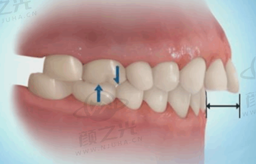 兰州海涛口腔医院最擅长什么?复杂种植、矫正修复等项目出色,附牙冠价格表