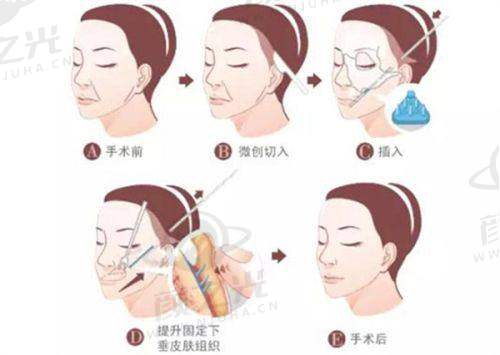 手术成效能维持多久?价格实惠不?