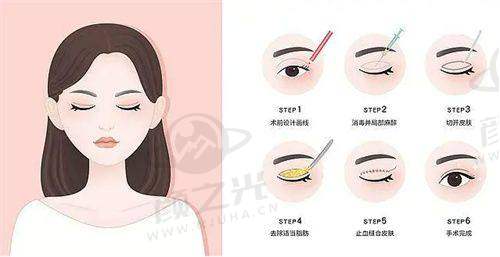 郭树忠耳再造为什么分三期?确保小耳再造成效好自然逼真,分阶段塑形是关键!