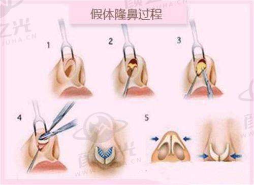 章庆国和潘博谁做耳朵好?抖音粉丝实测:章短周期,潘形态优价格亲民