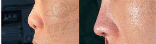 三、北京煤医医疗美容医院——大脚骨治疗行家