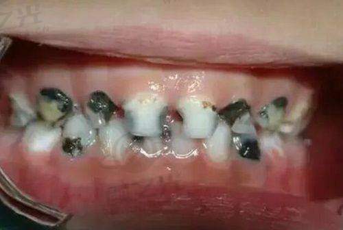 广西柳州蓝天口腔正规吗?有种植牙资质且收费合理,医生经验超丰富!