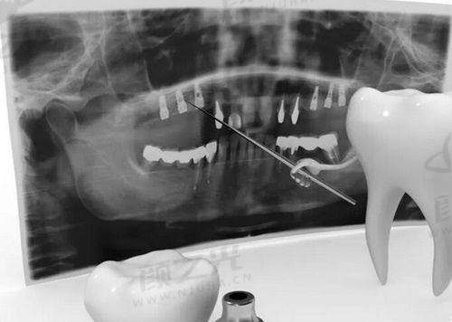 四、杭州富阳口腔医院补牙、拔牙、烤瓷牙项目收费详情